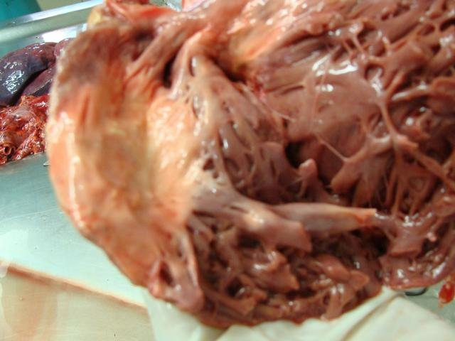 calcified cardia wall